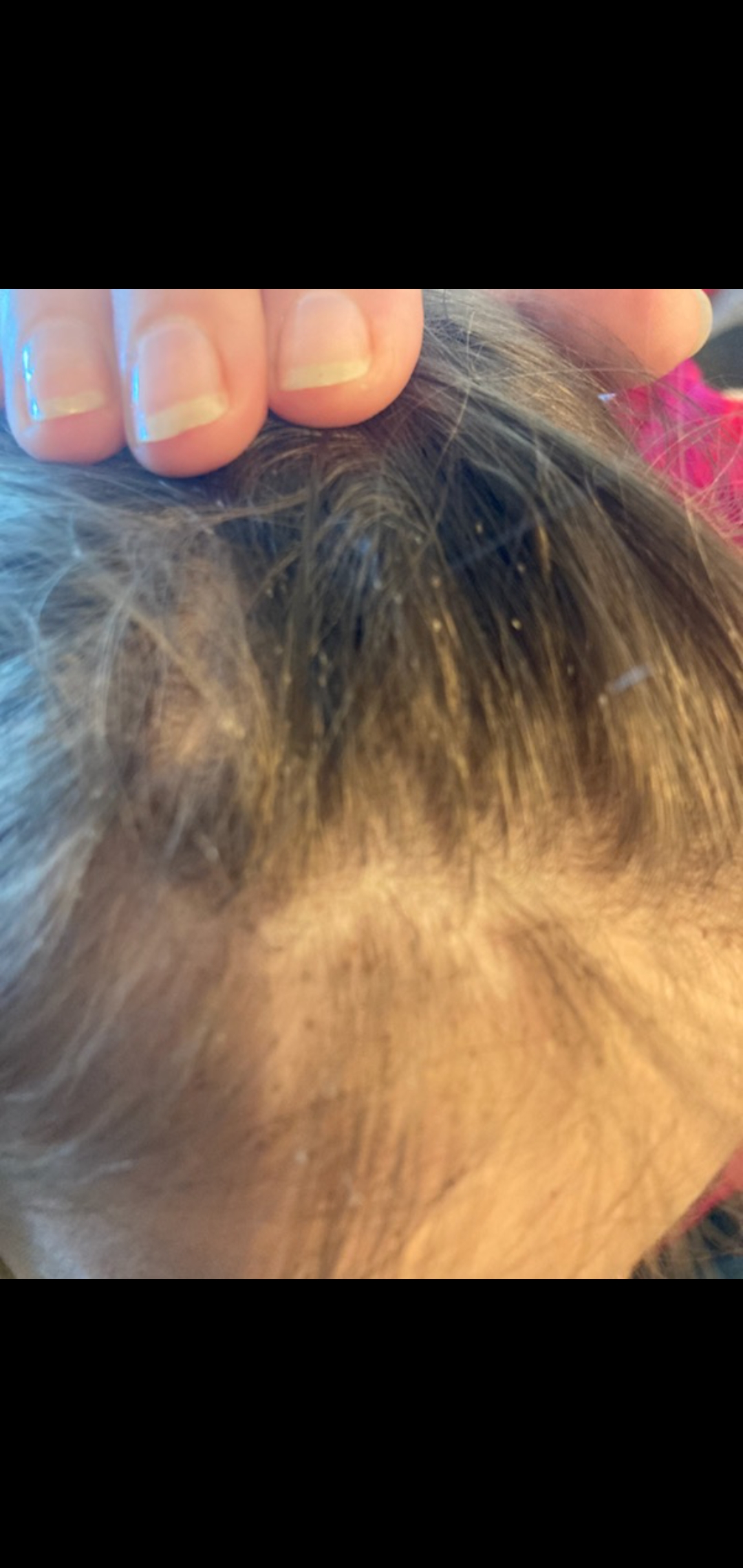 Lice Busters 805